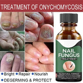 Fast Nail Fungal Treatments Nail Repair Essences Serum - Mall Mega