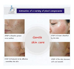 Bioaqua Anti Acne Cleanser For Removal Of Acne – 100ml - Mall Mega